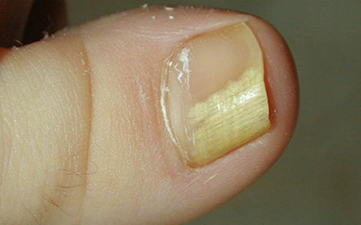 Отслоение ногтя